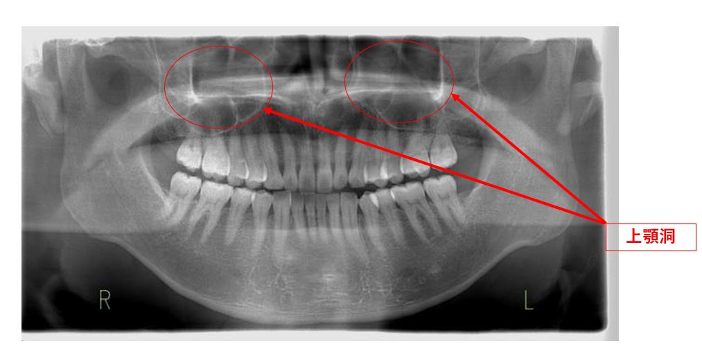 歯性上顎洞炎と副鼻腔炎について 銀座 東銀座の歯医者