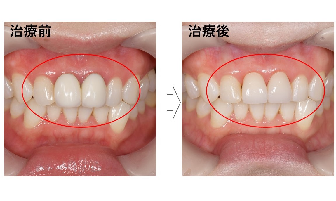 症例 不自然な前歯に対するジルコニアセラミックでの審美歯科治療 銀座 東銀座の歯医者