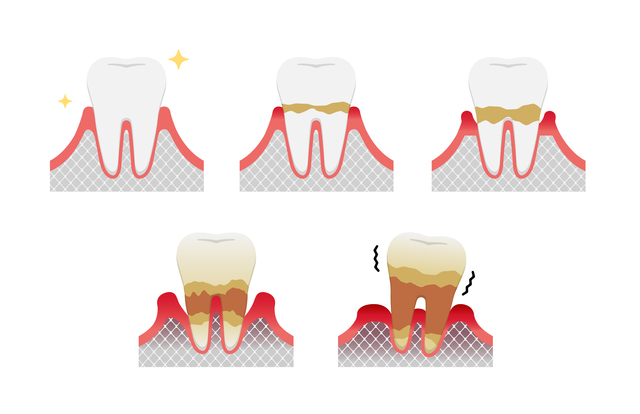 嚙み合わせの 力 と歯周病について 銀座 東銀座の歯医者