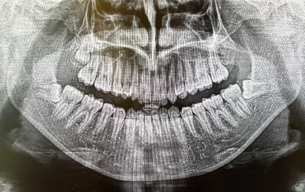 銀座みらい歯科｜ブログ｜歯科レントゲンについて｜パノラマX線写真
