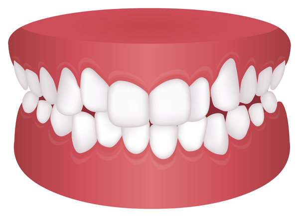 歯列接触癖（TCH）について