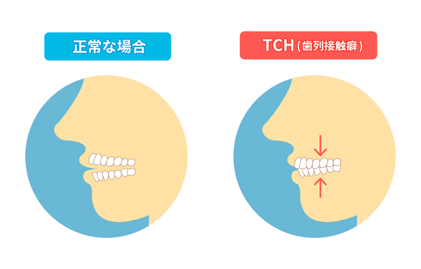 京橋 銀座みらい歯科｜歯科衛生士ブログ｜歯列接触癖（TCH）について｜画像1