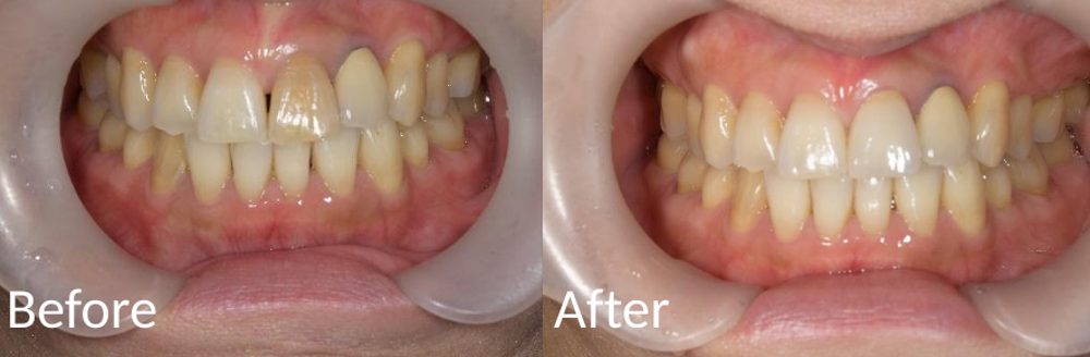 【症例】変色した前歯をセラミック治療で審美的に修復