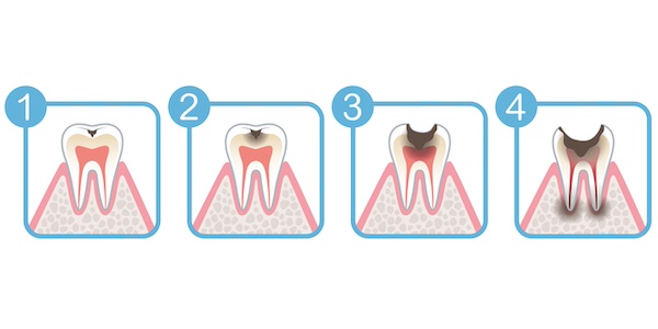 京橋 銀座みらい歯科｜歯科衛生士ブログ｜虫歯を放置したらどうなる？症状と健康リスク｜虫歯の症状の画像