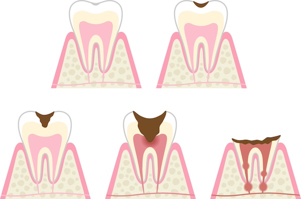 虫歯を放置したらどうなる？症状と健康リスク