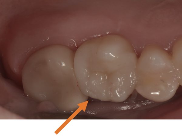 京橋 銀座みらい歯科|【症例】隣り合う歯の間に出来た大きな虫歯をセラミックによる治療_治療後