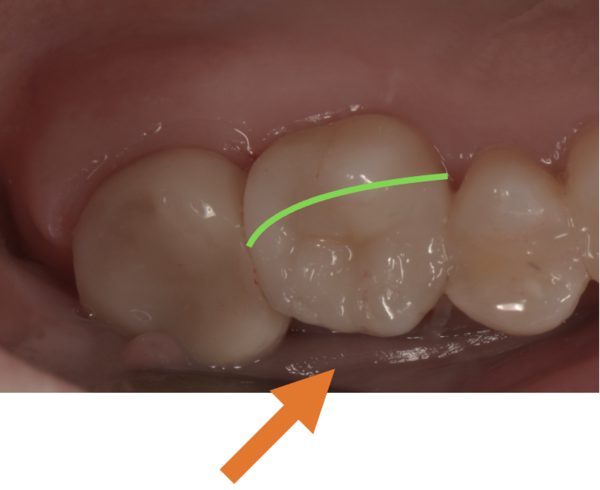 京橋 銀座みらい歯科|【症例】隣り合う歯の間に出来た大きな虫歯をセラミックによる治療_セラミック部分境界