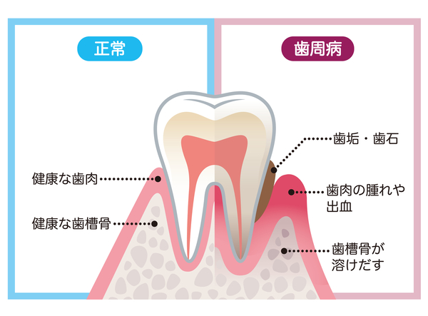 京橋 銀座みらい歯科｜歯科衛生士ブログ｜歯周病と糖尿病の意外な関係について｜画像1