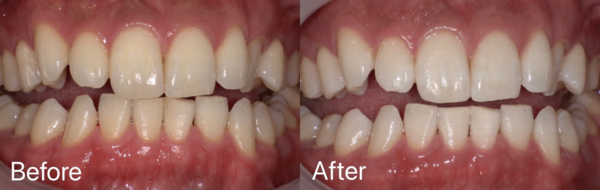 【症例】着色が気になる歯のオフィスホワイトニング
