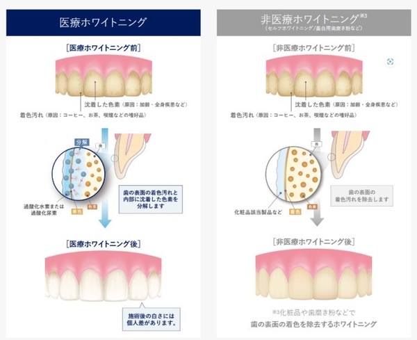 京橋 銀座みらい歯科｜歯科衛生士ブログ｜ホームホワイトニングウィズが新登場！｜画像1